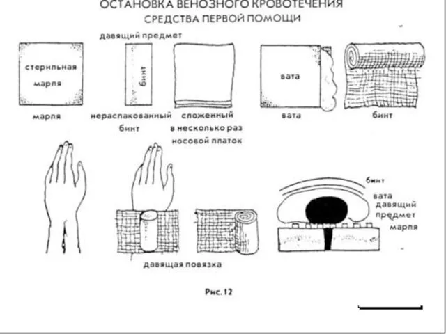 Помощь при венозном кровотечении Наложение давящей повязки. Непосредственно на кровоточащую