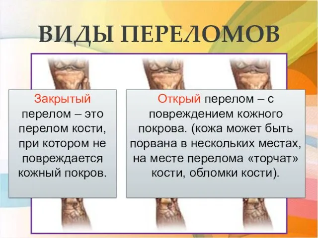 ВИДЫ ПЕРЕЛОМОВ Закрытый перелом – это перелом кости, при котором