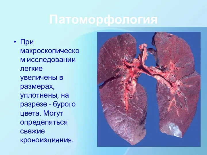 Патоморфология При макроскопическом исследовании легкие увеличены в размерах, уплотнены, на