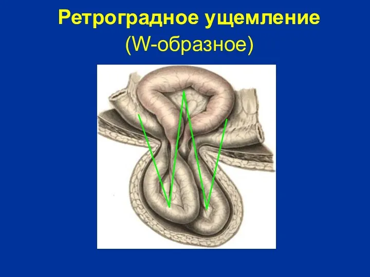 Ретроградное ущемление (W-образное)