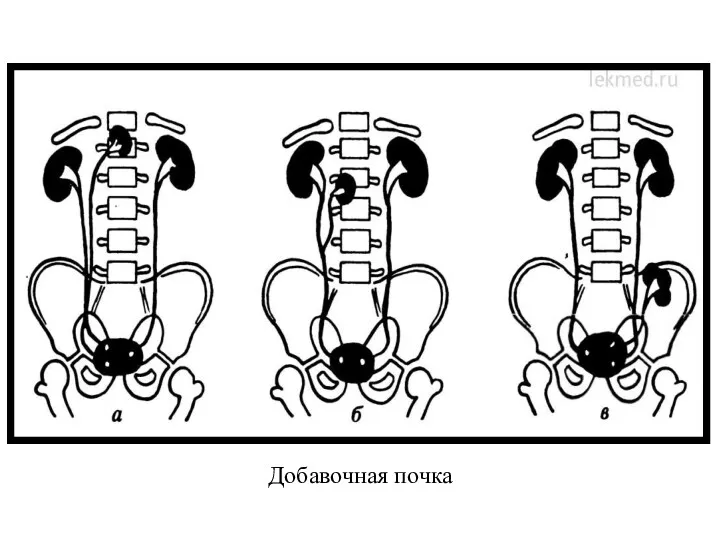 Добавочная почка