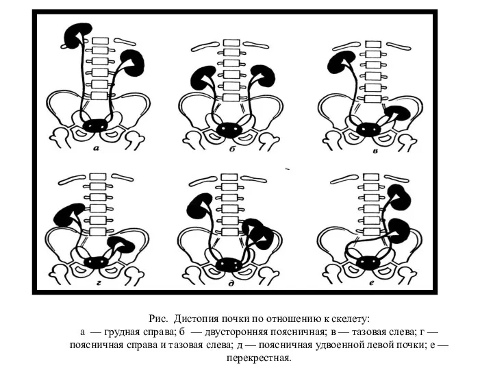 Рис. Дистопия почки по отношению к скелету: а — грудная