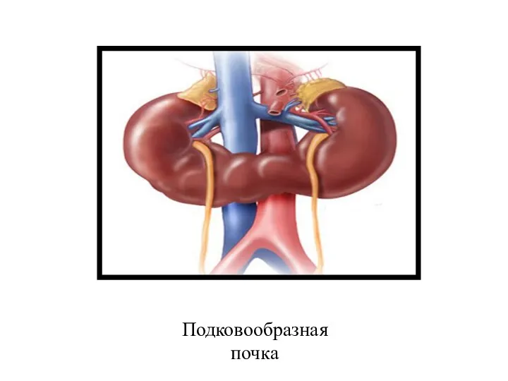 Подковообразная почка