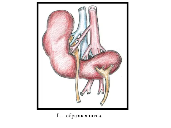 L – образная почка