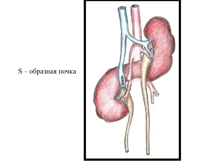 S – образная почка