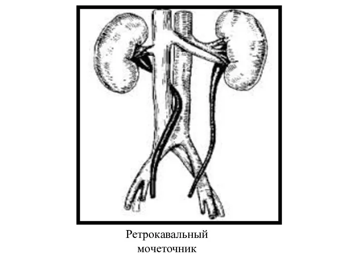 Ретрокавальный мочеточник