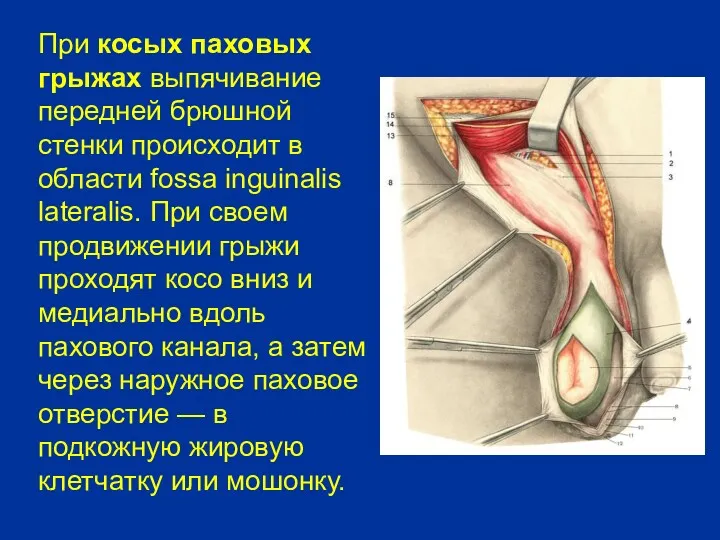 При косых паховых грыжах выпячивание передней брюшной стенки происходит в