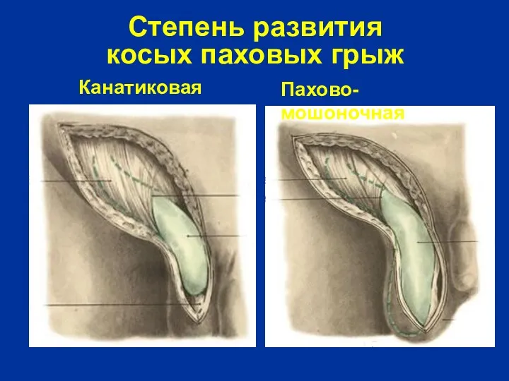 Степень развития косых паховых грыж Канатиковая Пахово-мошоночная