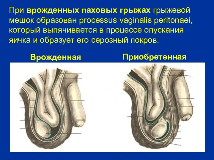 При врожденных паховых грыжах грыжевой мешок образован processus vaginalis peritonaei,