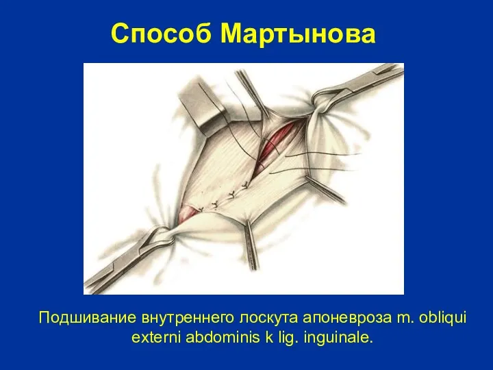 Подшивание внутреннего лоскута апоневроза m. obliqui externi abdominis k lig. inguinale. Способ Мартынова