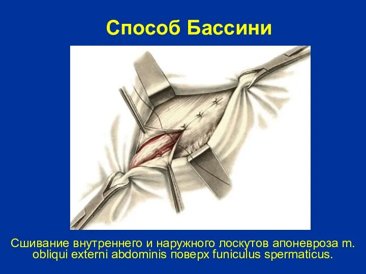 Сшивание внутреннего и наружного лоскутов апоневроза m. obliqui externi abdominis поверх funiculus spermaticus. Способ Бассини