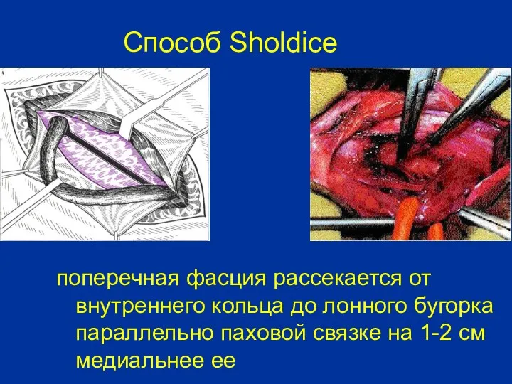 Способ Sholdice поперечная фасция рассекается от внутреннего кольца до лонного