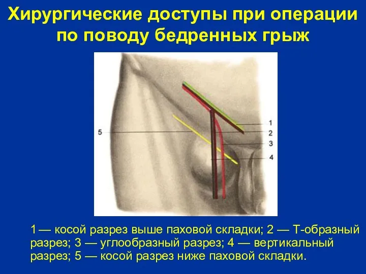 Хирургические доступы при операции по поводу бедренных грыж 1 —