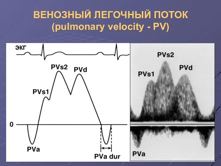 ВЕНОЗНЫЙ ЛЕГОЧНЫЙ ПОТОК (pulmonary velocity - PV)