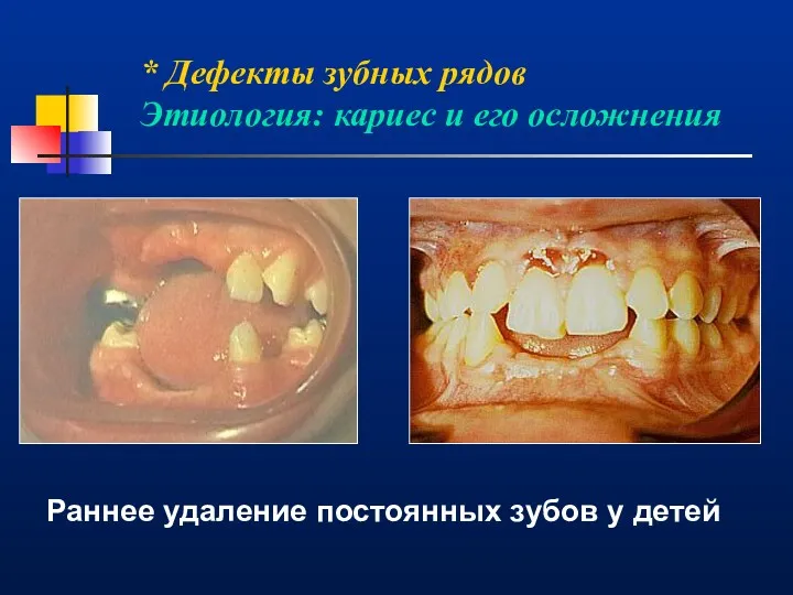 * Дефекты зубных рядов Этиология: кариес и его осложнения Раннее удаление постоянных зубов у детей