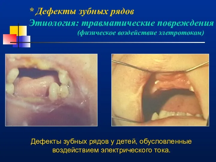 * Дефекты зубных рядов Этиология: травматические повреждения (физическое воздействие элетротоком)
