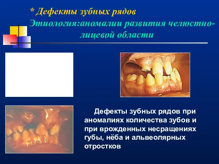 * Дефекты зубных рядов Этиология:аномалии развития челюстно- лицевой области Дефекты