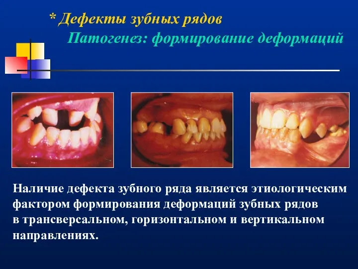 * Дефекты зубных рядов Патогенез: формирование деформаций Наличие дефекта зубного