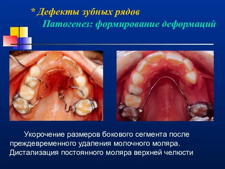 * Дефекты зубных рядов Патогенез: формирование деформаций Укорочение размеров бокового