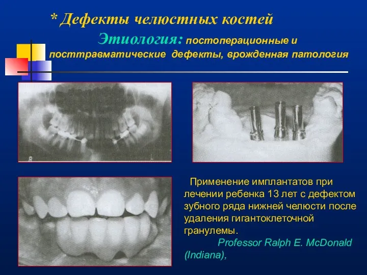 * Дефекты челюстных костей Этиология: постоперационные и посттравматические дефекты, врожденная