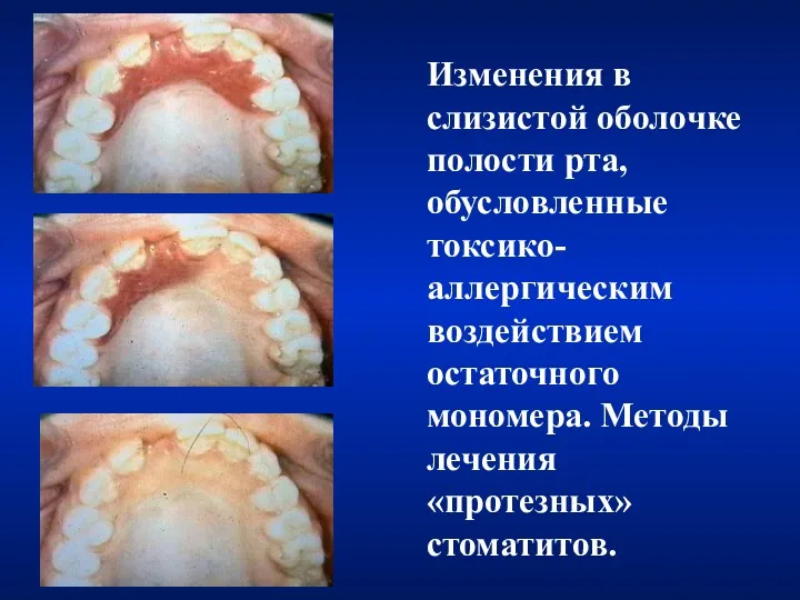 Изменения в слизистой оболочке полости рта, обусловленные токсико-аллергическим воздействием остаточного мономера. Методы лечения «протезных» стоматитов.