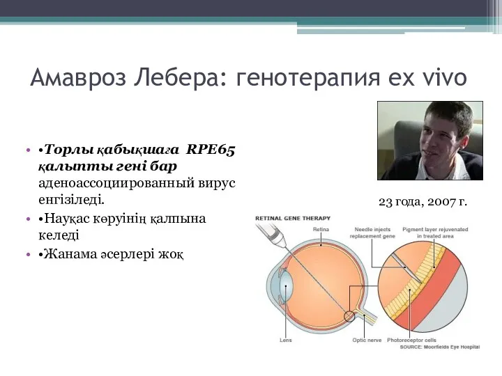 Амавроз Лебера: генотерапия ex vivo •Торлы қабықшаға RPE65 қалыпты гені