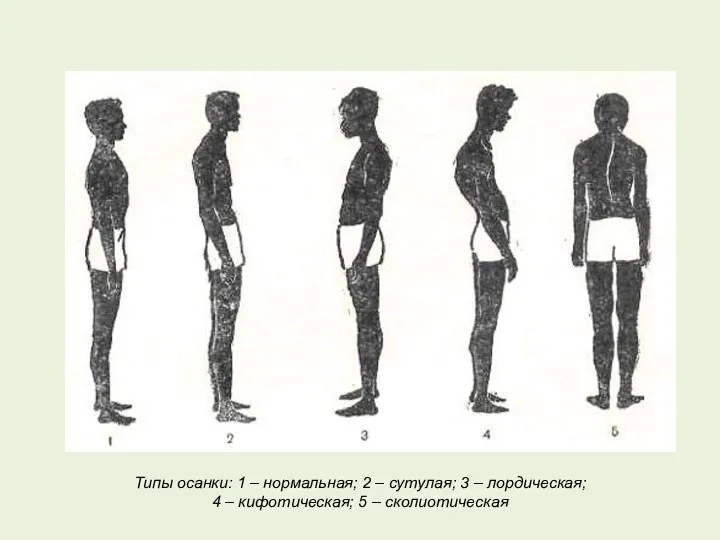 Типы осанки: 1 – нормальная; 2 – сутулая; 3 –