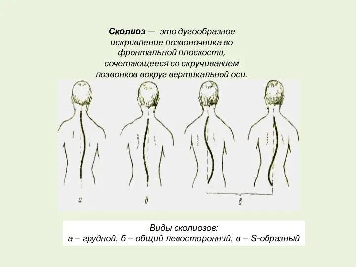 Виды сколиозов: а – грудной, б – общий левосторонний, в – S-образный Сколиоз