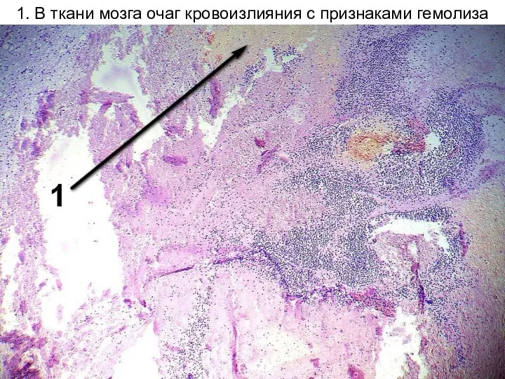 1. В ткани мозга очаг кровоизлияния с признаками гемолиза