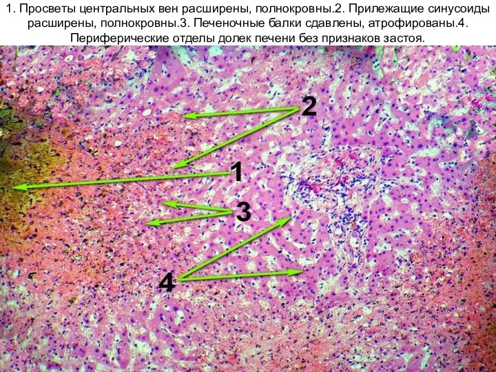 1. Просветы центральных вен расширены, полнокровны.2. Прилежащие синусоиды расширены, полнокровны.3.