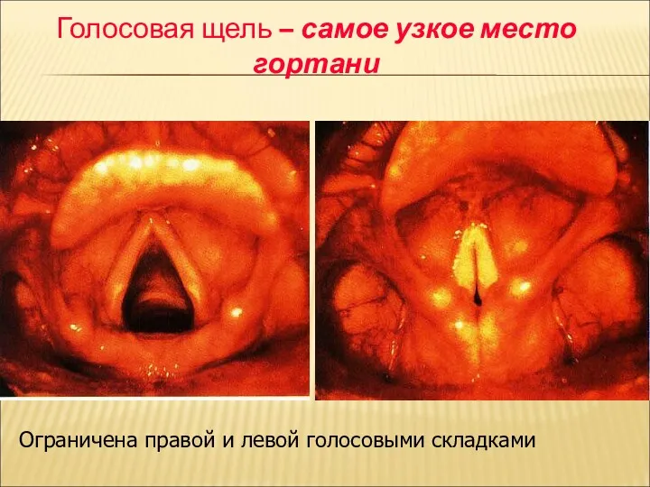 Голосовая щель – самое узкое место гортани Ограничена правой и левой голосовыми складками