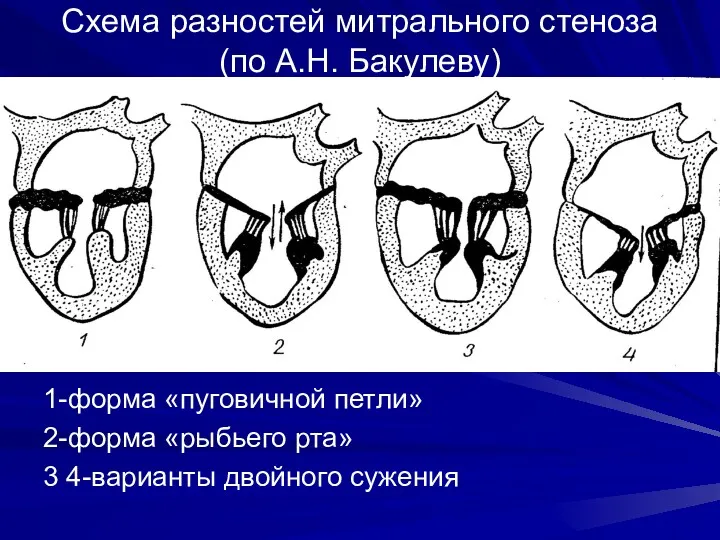 Схема разностей митрального стеноза (по А.Н. Бакулеву) 1-форма «пуговичной петли»
