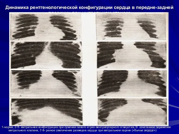 Динамика рентгенологической конфигурации сердца в передне-задней проекции при митральном стенозе