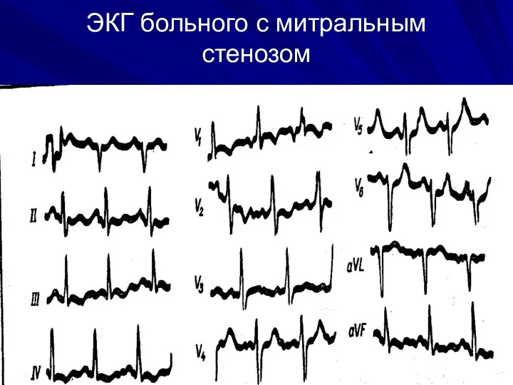 ЭКГ больного с митральным стенозом