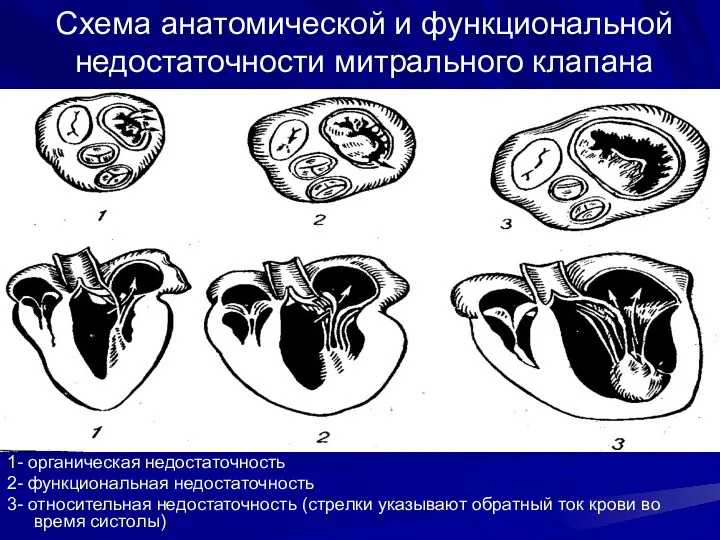 Схема анатомической и функциональной недостаточности митрального клапана 1- органическая недостаточность