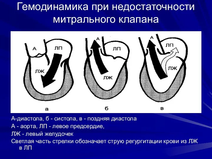 Гемодинамика при недостаточности митрального клапана А-диастола, б - систола, в