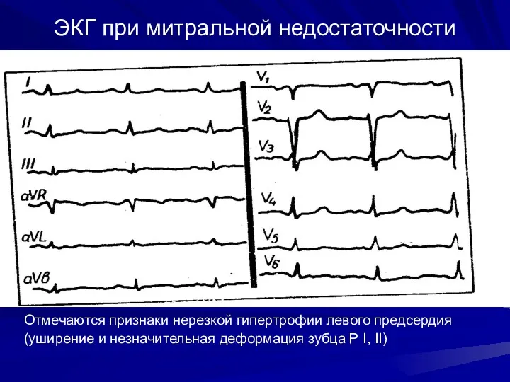 ЭКГ при митральной недостаточности Отмечаются признаки нерезкой гипертрофии левого предсердия