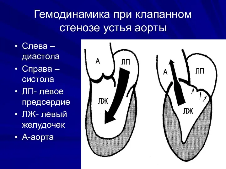 Гемодинамика при клапанном стенозе устья аорты Слева – диастола Справа