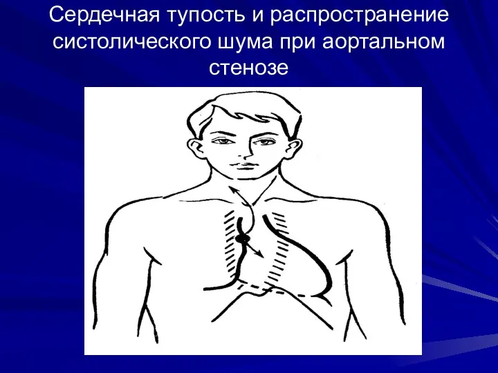 Сердечная тупость и распространение систолического шума при аортальном стенозе