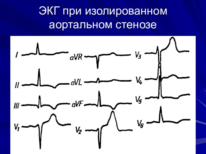 ЭКГ при изолированном аортальном стенозе