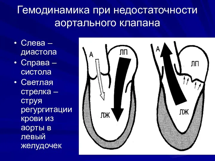 Гемодинамика при недостаточности аортального клапана Слева –диастола Справа – систола