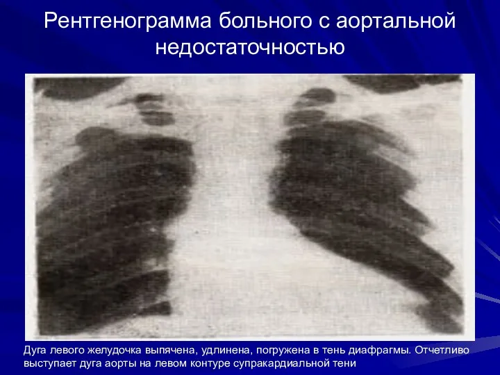 Рентгенограмма больного с аортальной недостаточностью Дуга левого желудочка выпячена, удлинена,