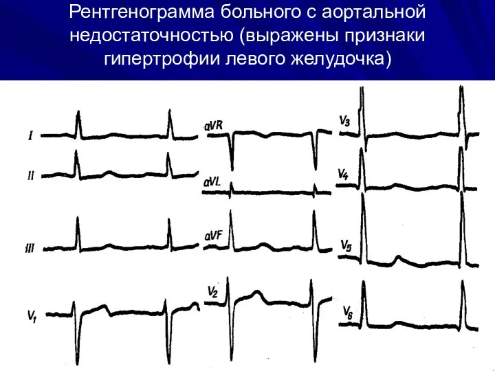 Рентгенограмма больного с аортальной недостаточностью (выражены признаки гипертрофии левого желудочка)