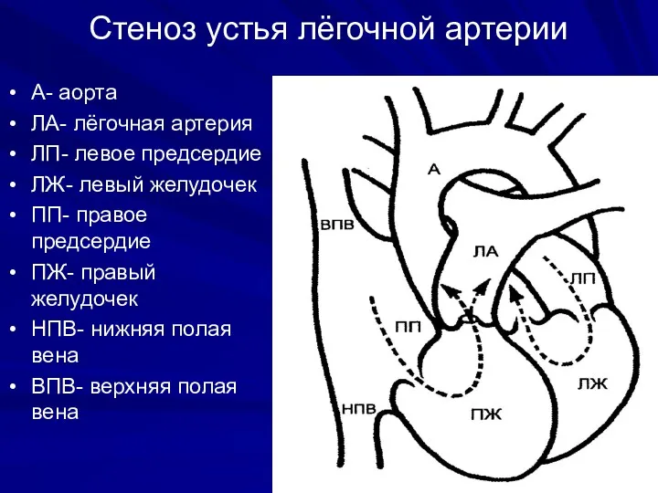 Стеноз устья лёгочной артерии А- аорта ЛА- лёгочная артерия ЛП-