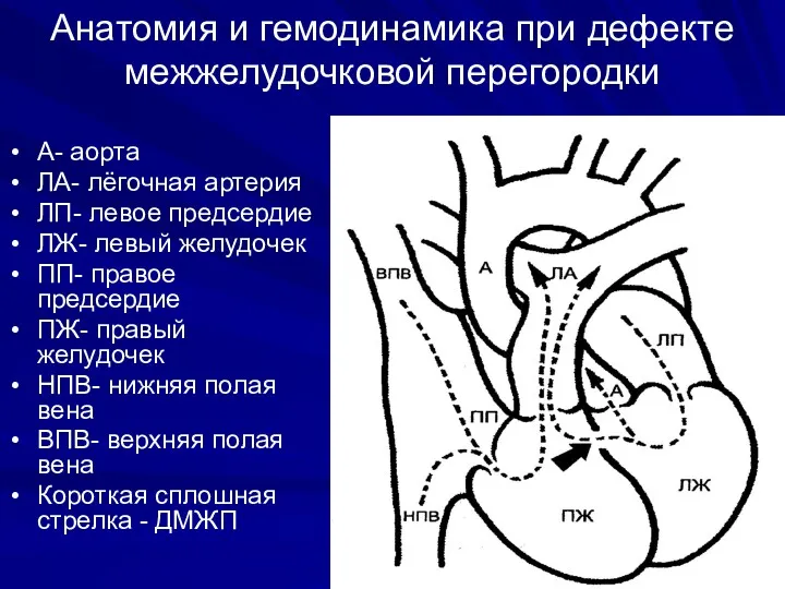 Анатомия и гемодинамика при дефекте межжелудочковой перегородки А- аорта ЛА-