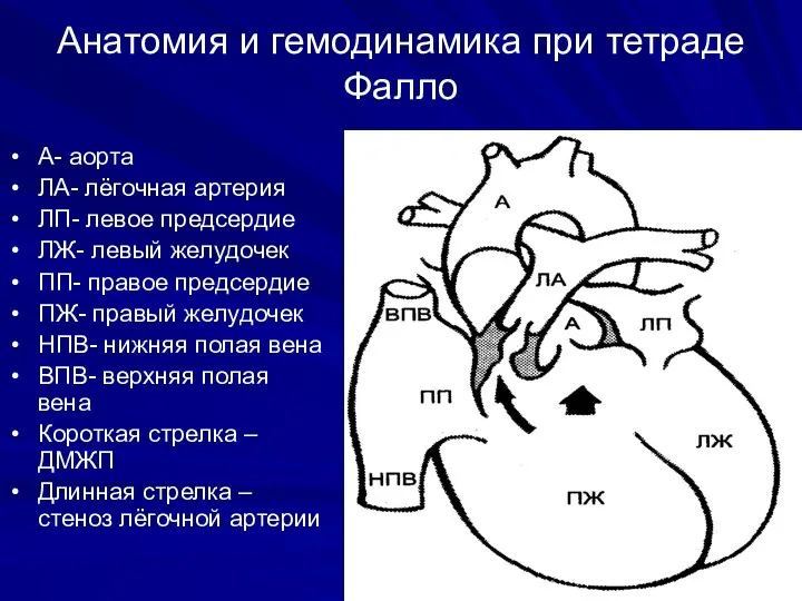 Анатомия и гемодинамика при тетраде Фалло А- аорта ЛА- лёгочная