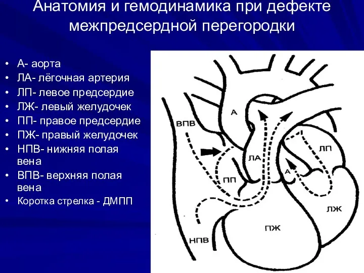 Анатомия и гемодинамика при дефекте межпредсердной перегородки А- аорта ЛА-