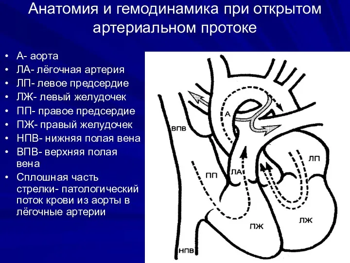 Анатомия и гемодинамика при открытом артериальном протоке А- аорта ЛА-