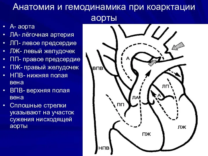 Анатомия и гемодинамика при коарктации аорты А- аорта ЛА- лёгочная