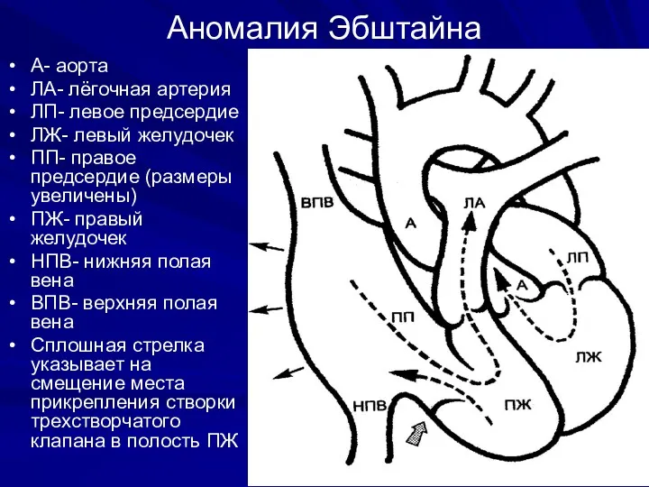 Аномалия Эбштайна А- аорта ЛА- лёгочная артерия ЛП- левое предсердие